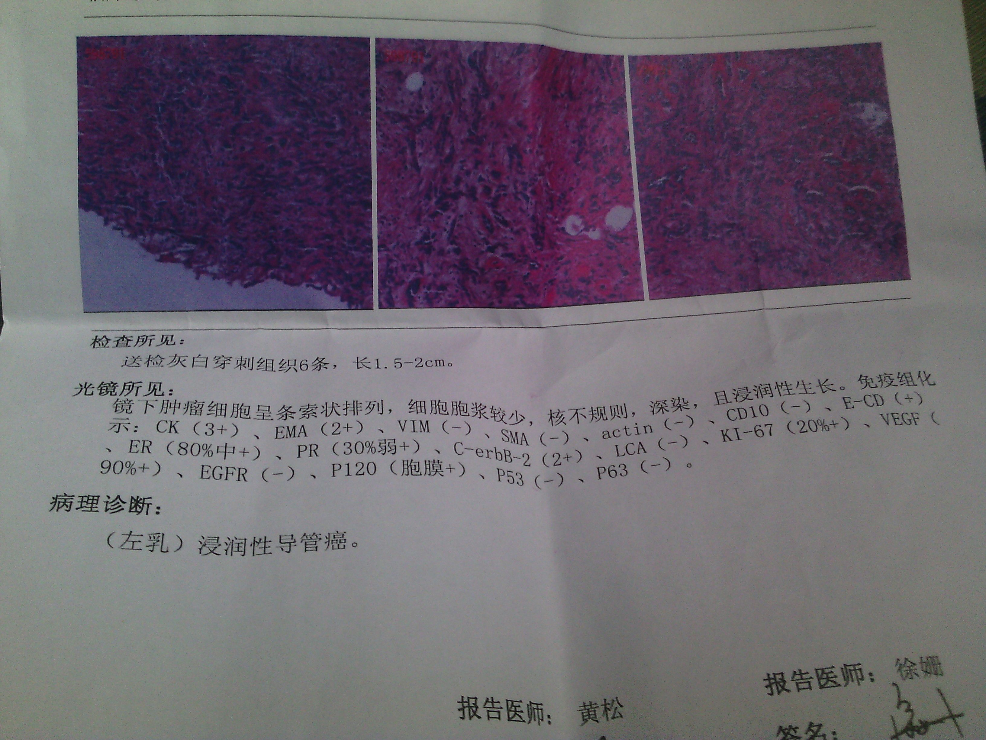 乳腺癌免疫组化.是什么意思