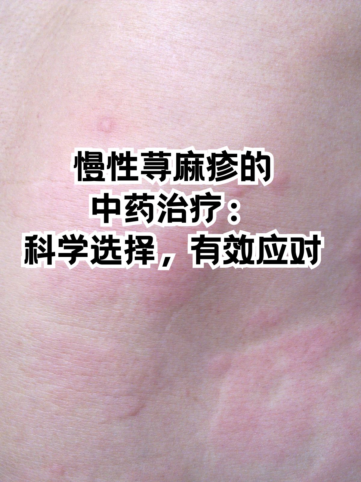 荨麻疹多久能好..