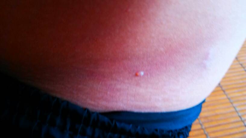 脸上长红色的点点是什么情况?