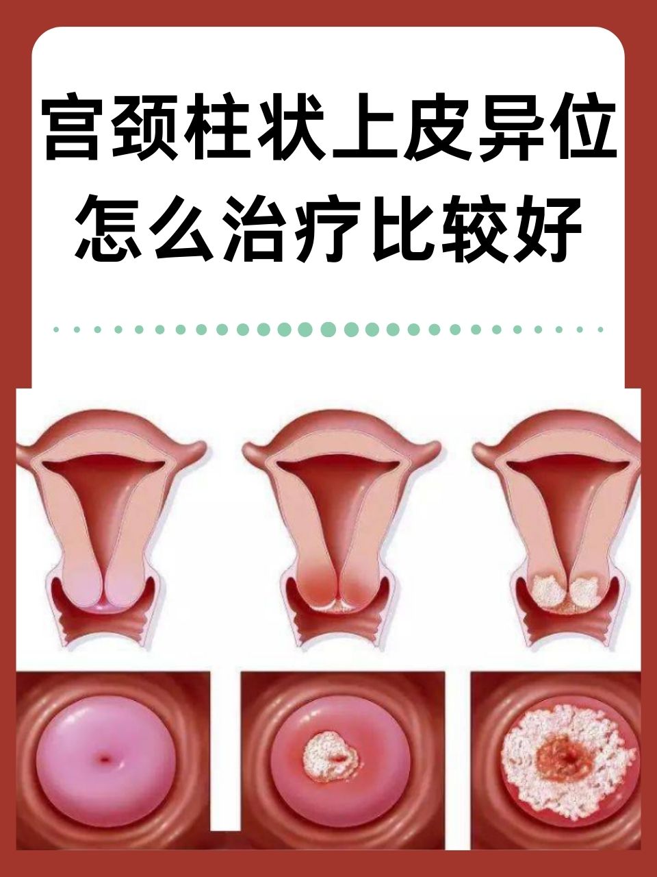 宫颈糜烂怎样治愈?