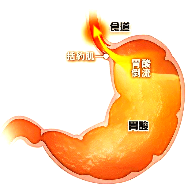 胃食管反流病的临床表现