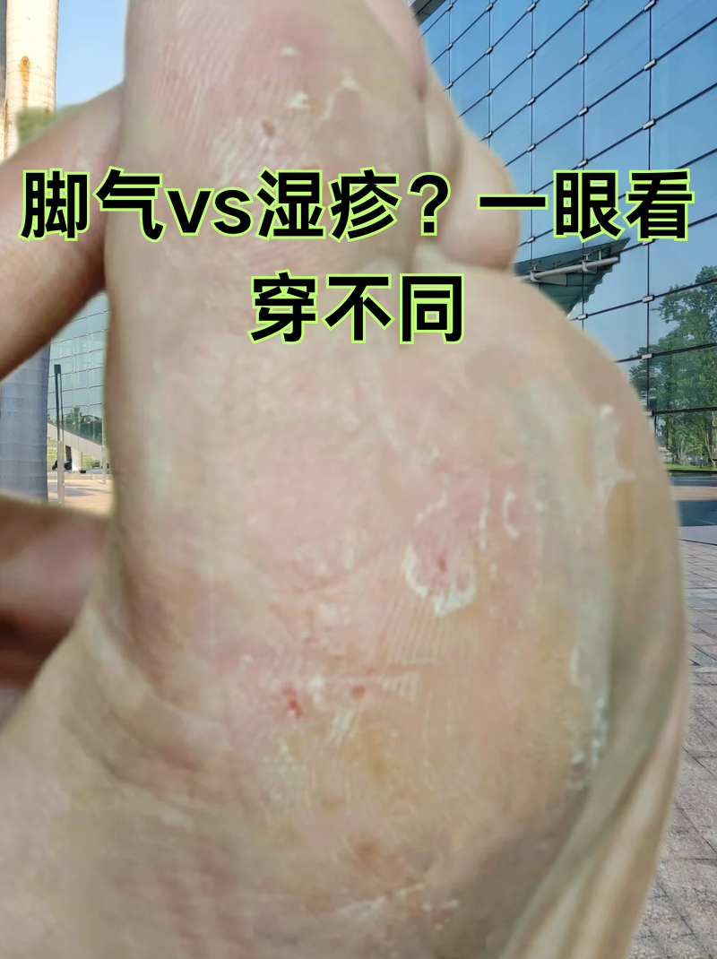 脚上湿疹和脚气的区别