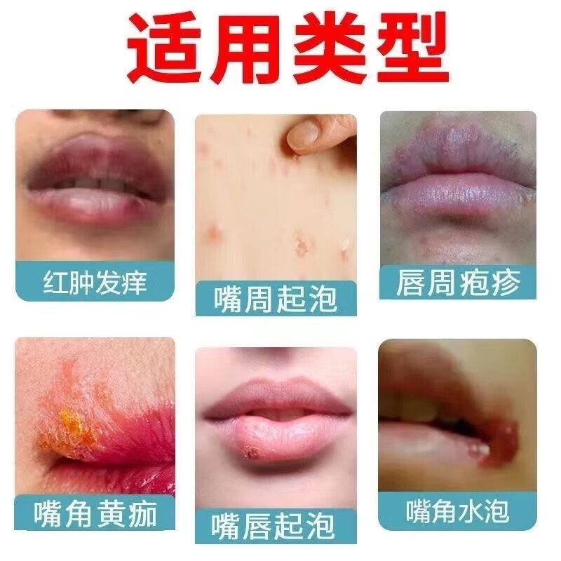 烂嘴角怎么办??????