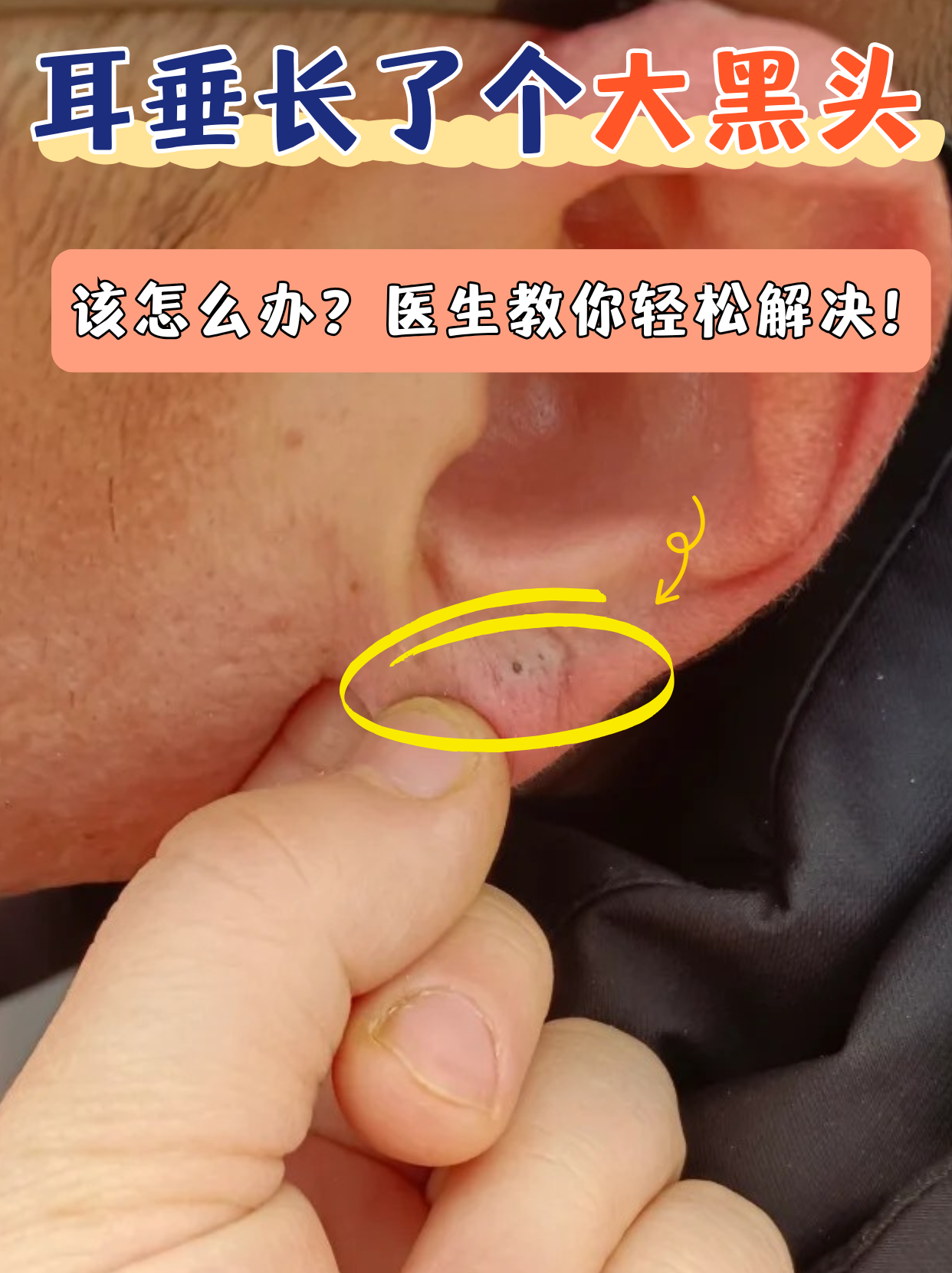 粉瘤为什么会长在耳垂上呢