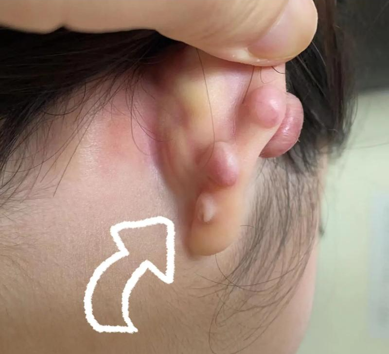 粉瘤为什么会长在耳垂上呢