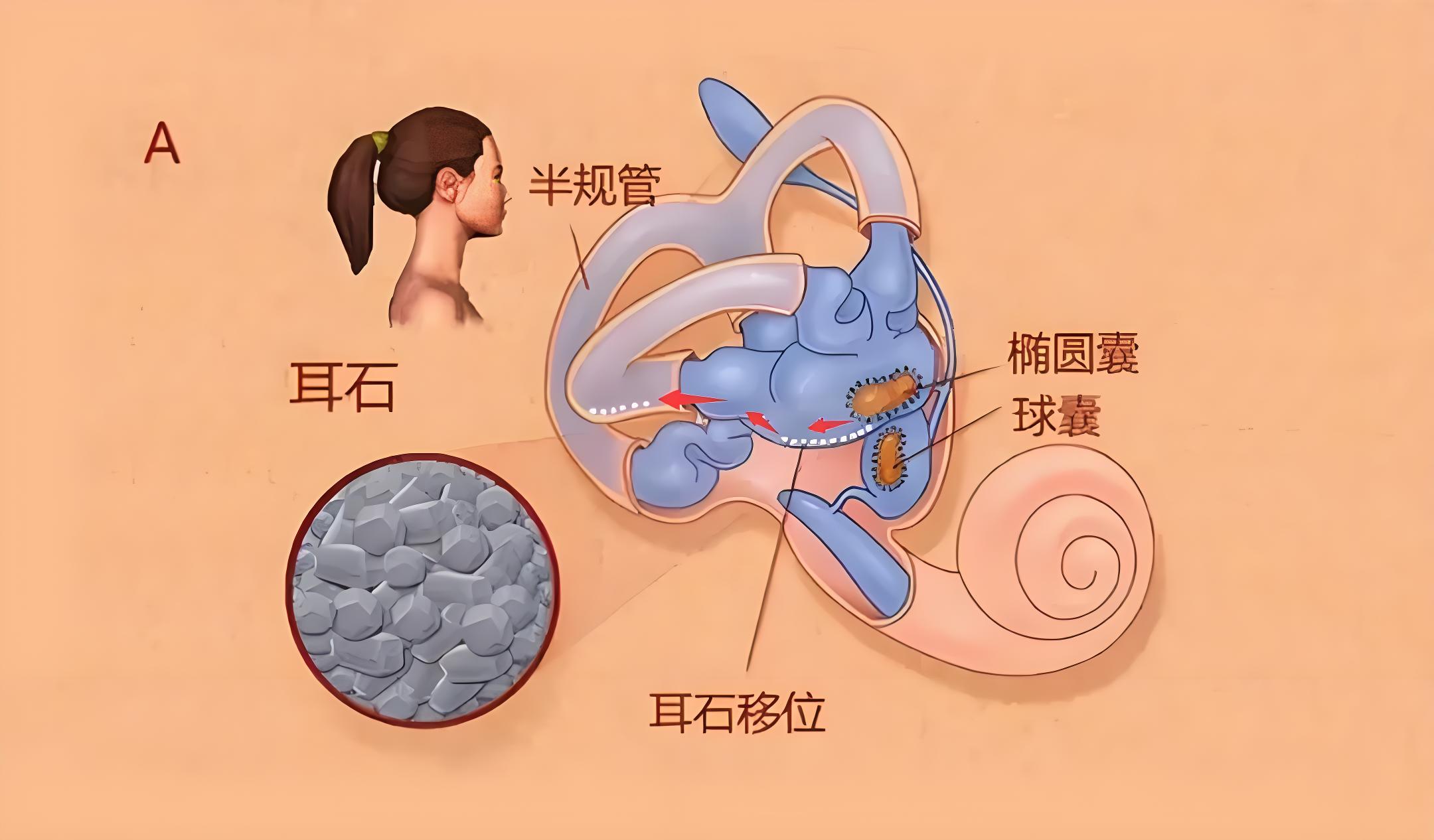 耳石症可以自己在家里复位吗