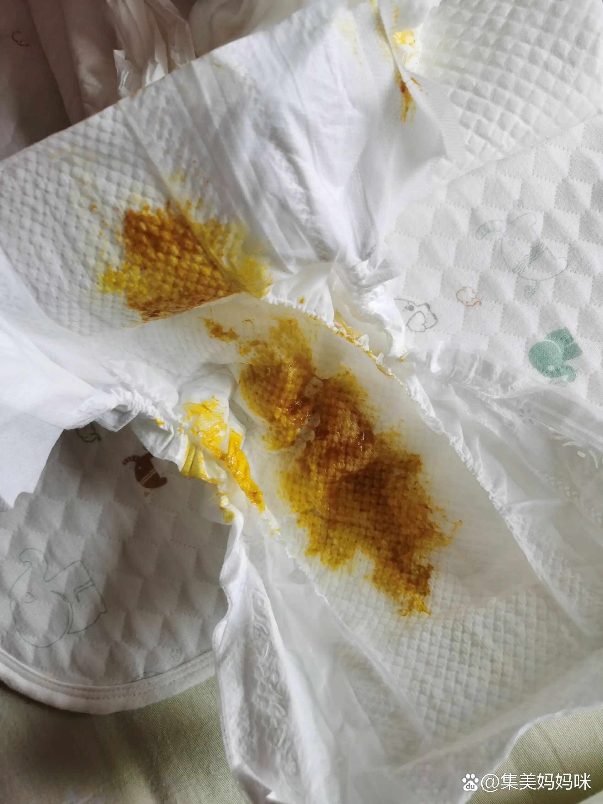 新生儿大便有血丝