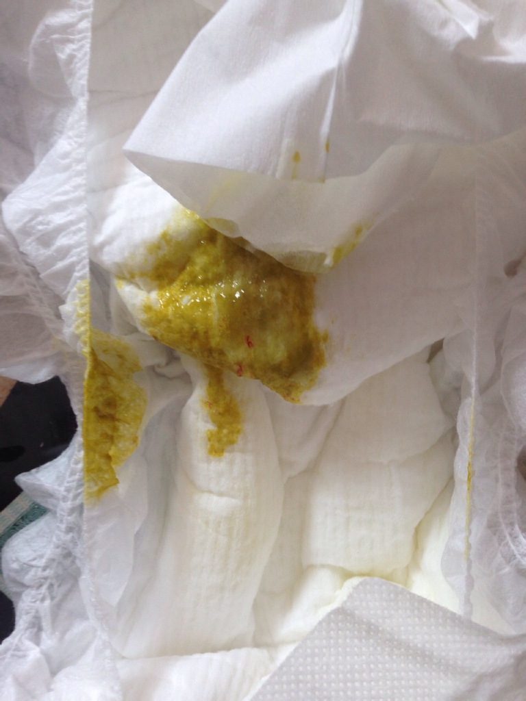 新生儿大便有血丝