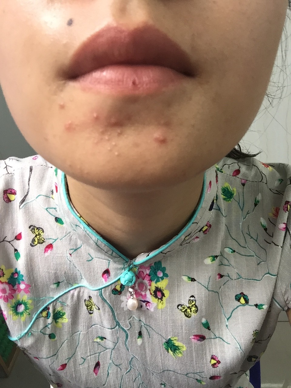 嘴下边长痘是怎么回事