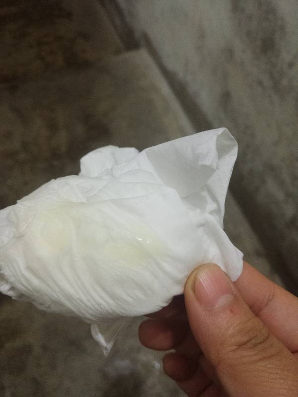 白带发黄不痛不痒