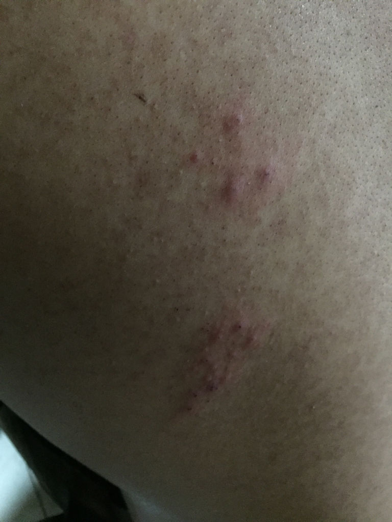 后背长红疙瘩很痒...