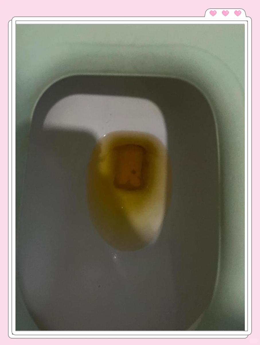 新生儿尿液发黄