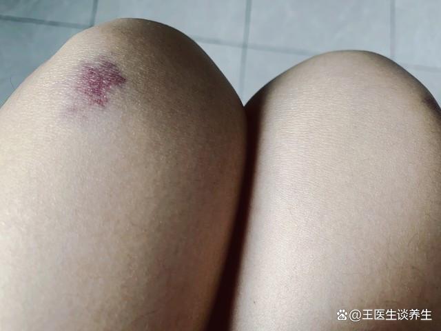 儿童白血病的早期症状