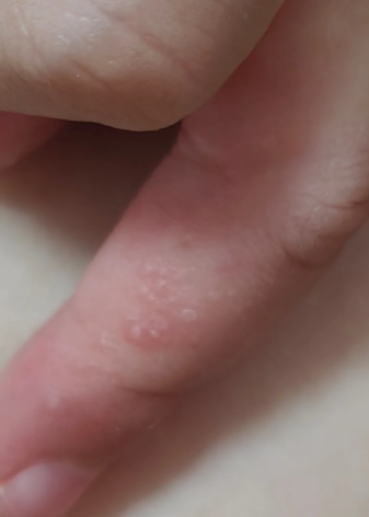 孕妇手上长上长湿疹怎么办?