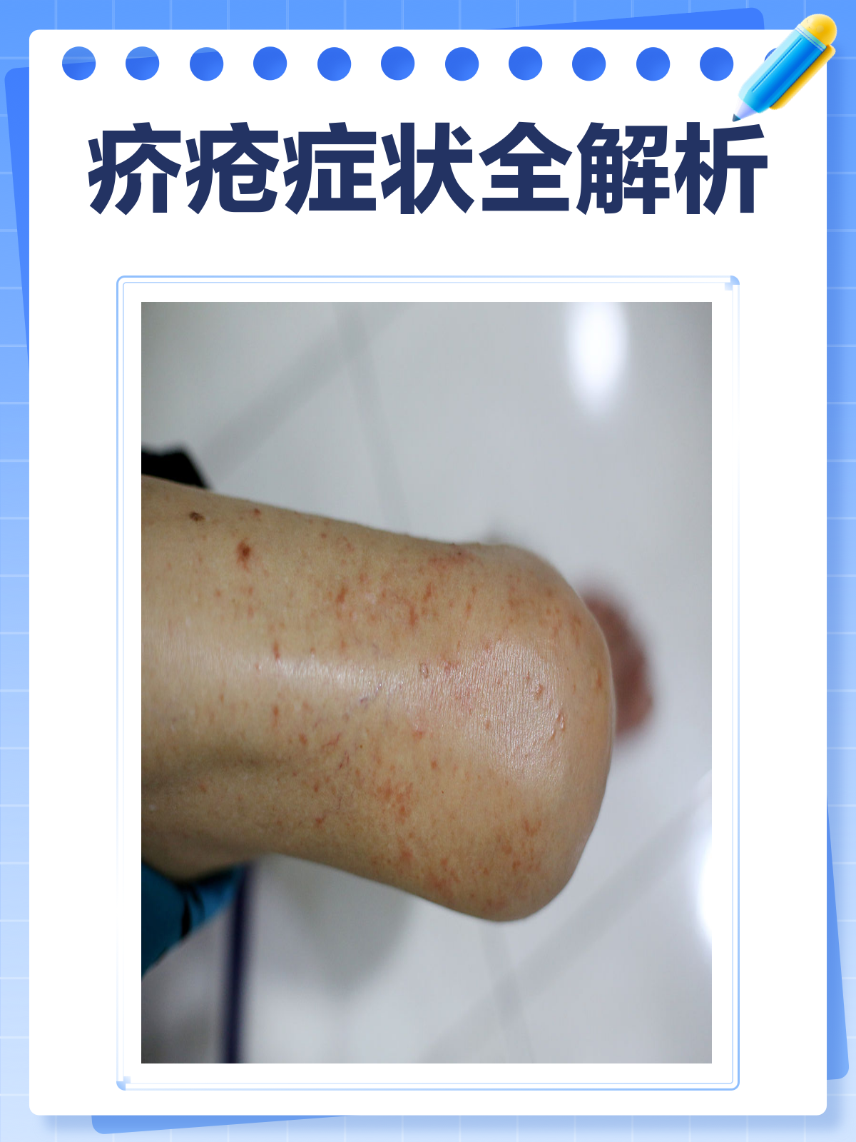 疥疮怎么引起的?