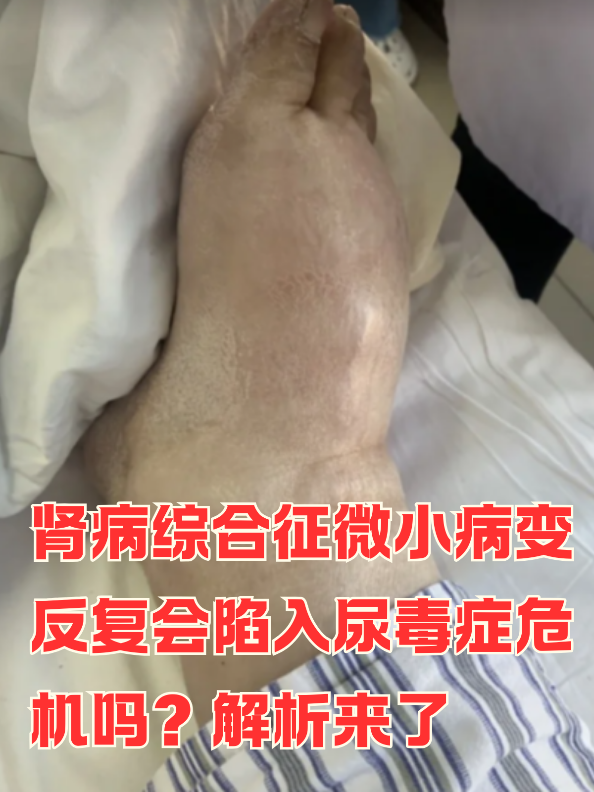 尿毒症会遗传吗