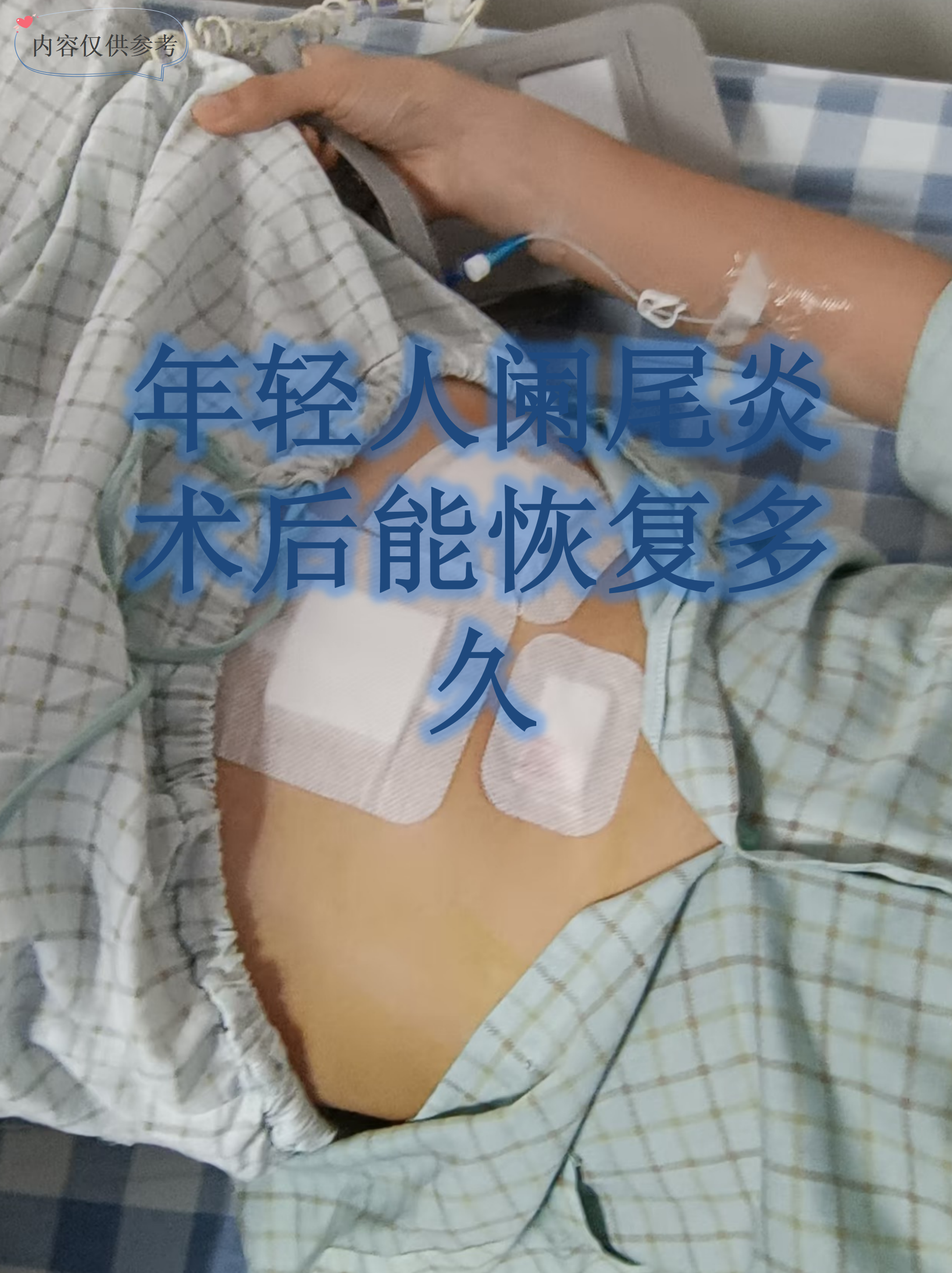 阑尾炎手术几天出院