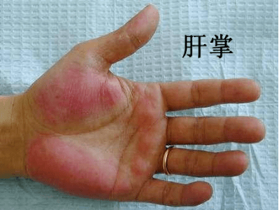 右肩膀酸痛多久是肝癌