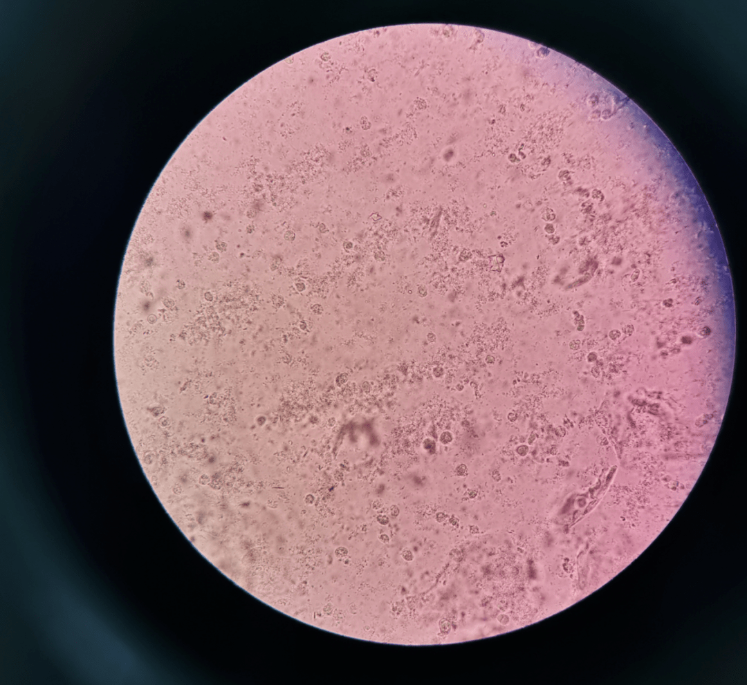 验白带:白细胞是什么