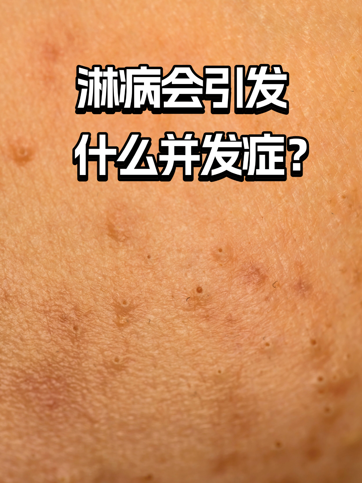 淋病有哪些主要症状