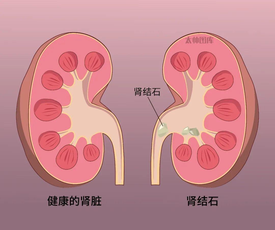 什么是泌尿系统结石
