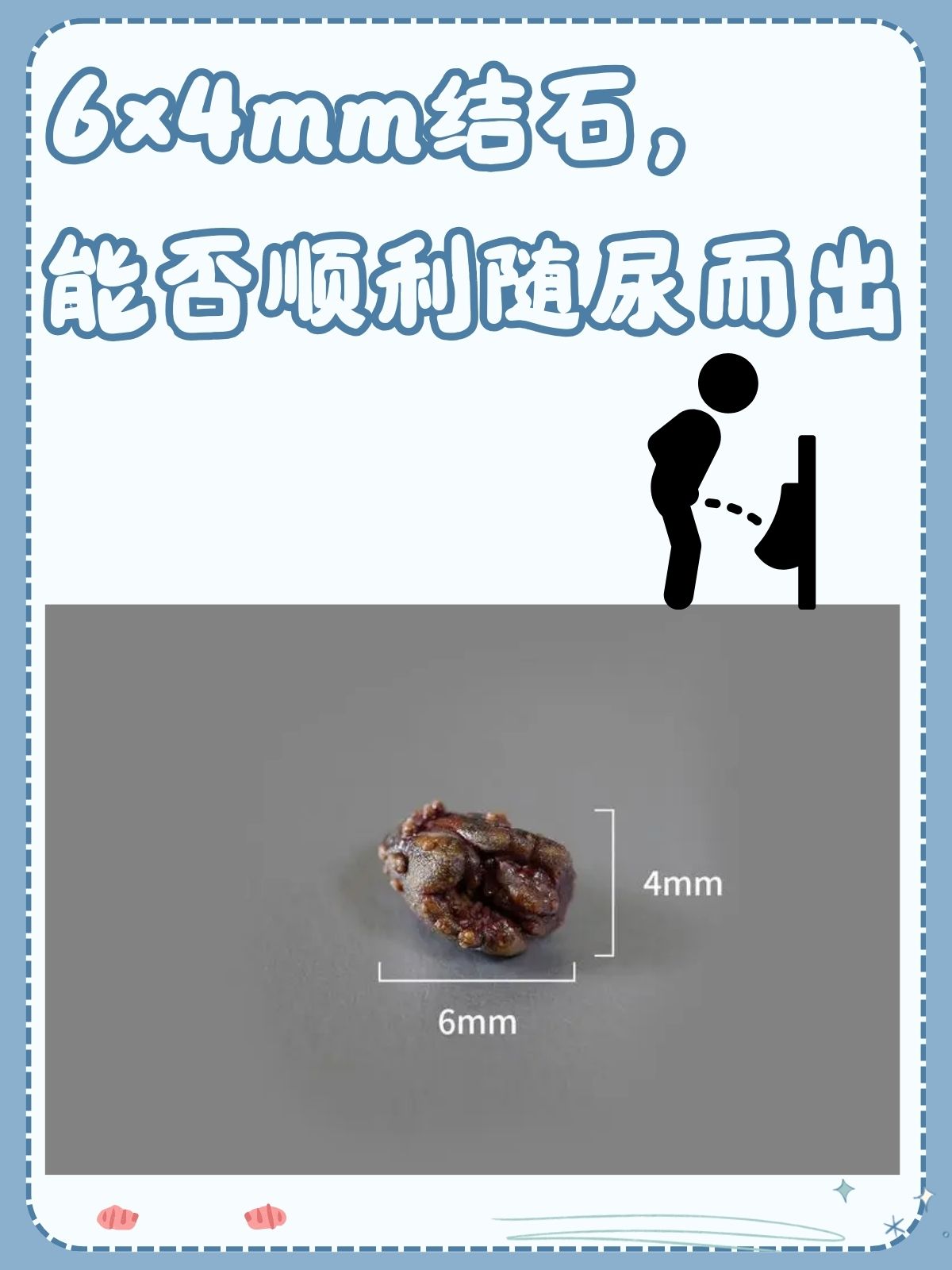 什么是泌尿系统结石