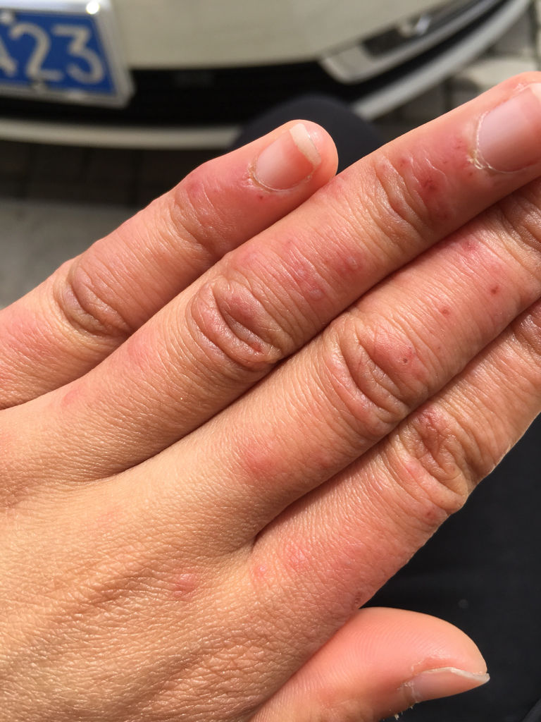 宝宝手心很热怎么回事