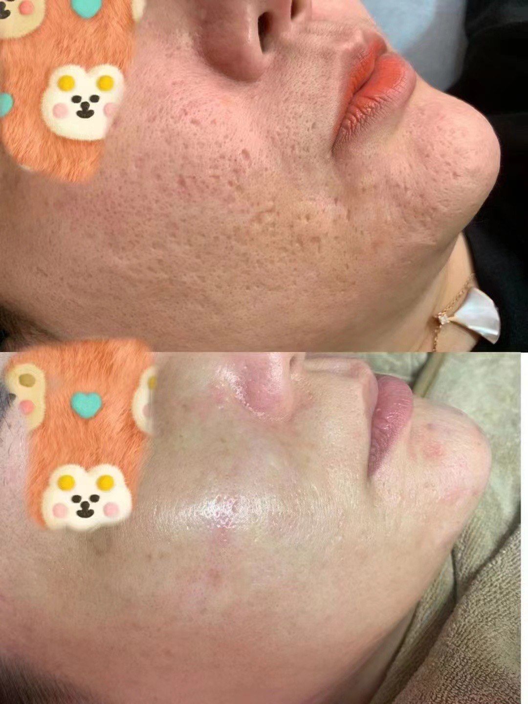 痘坑能自己修复吗