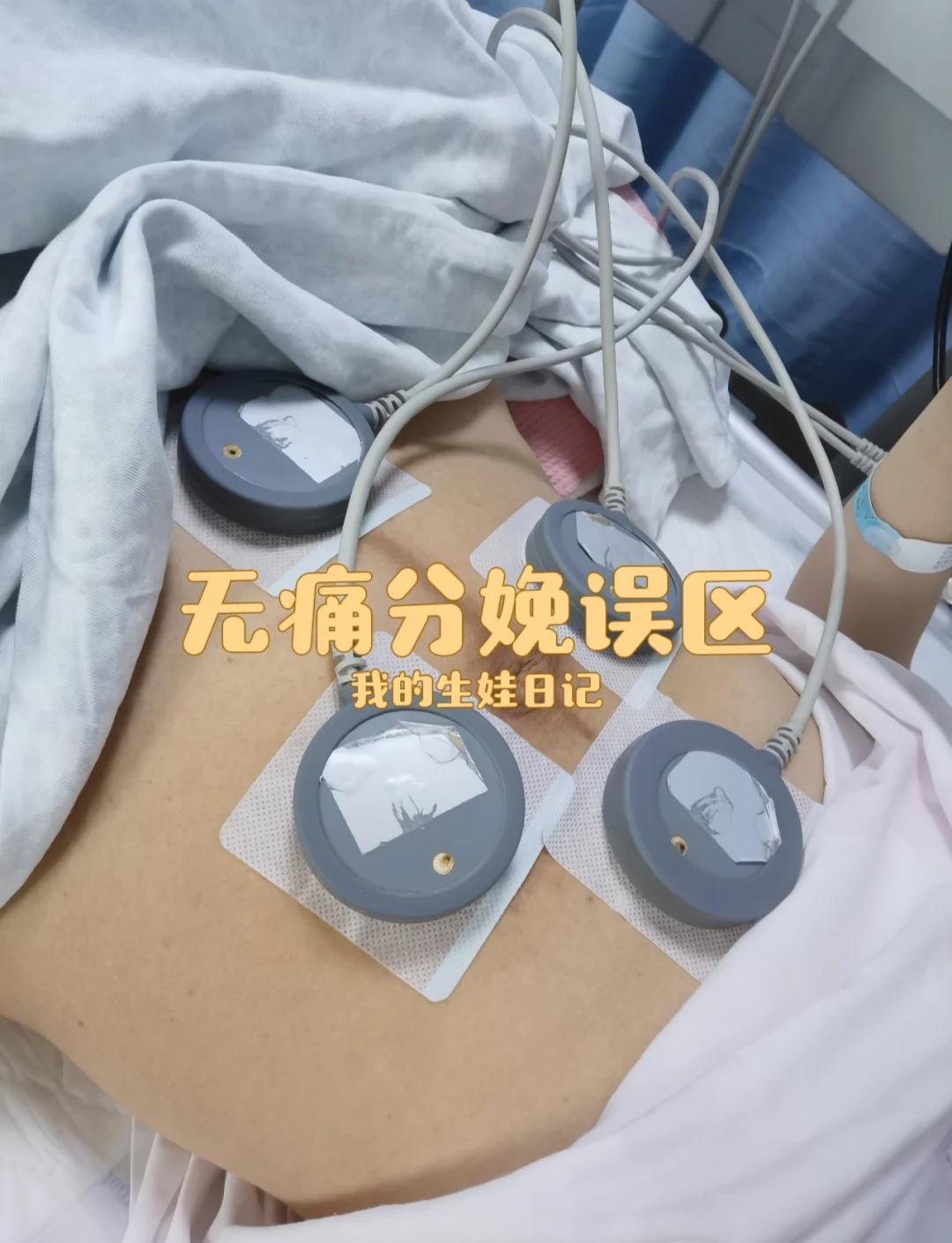 什么叫无痛分娩