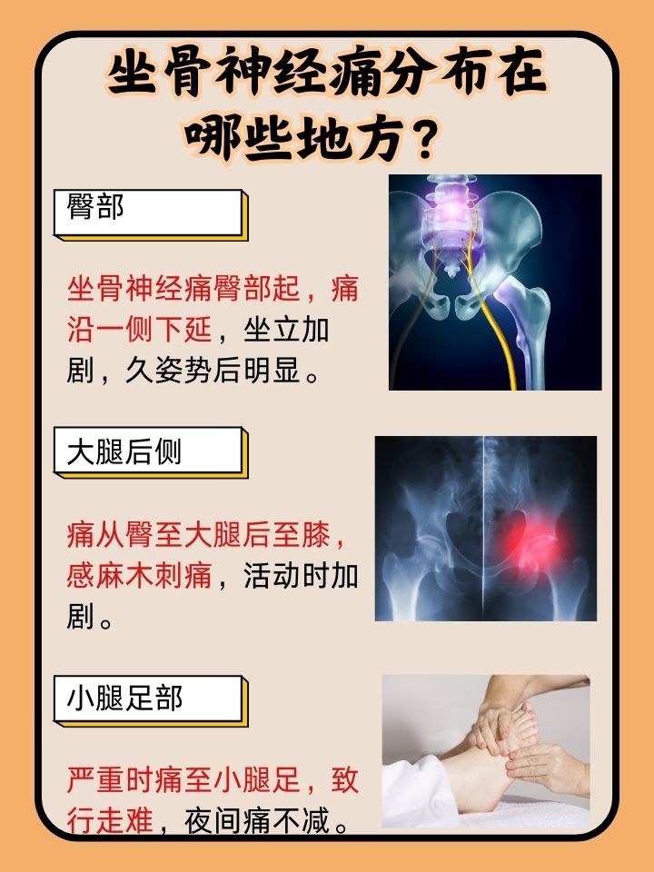坐骨神经疼痛怎么办
