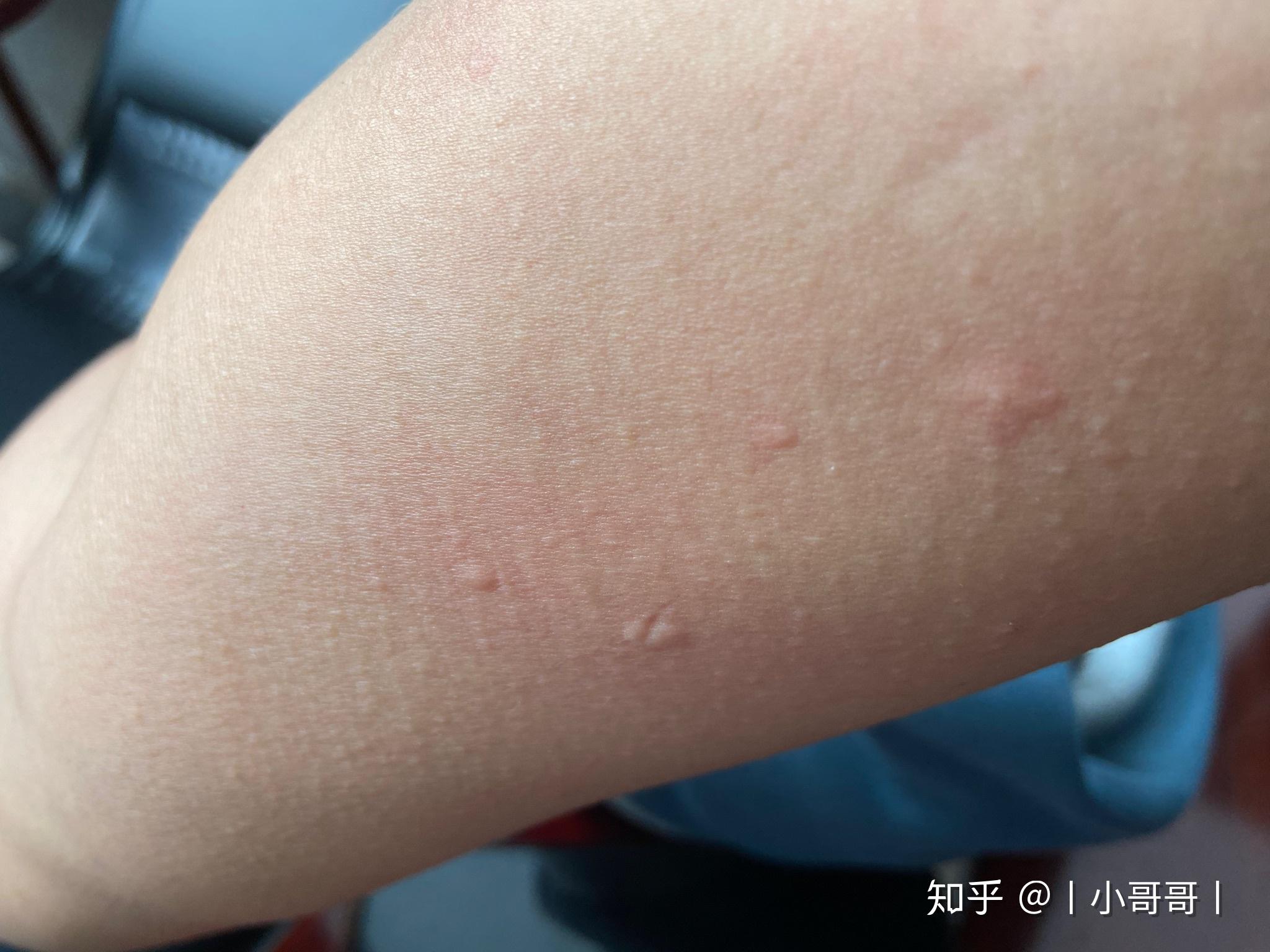 身上无缘无故起包很痒