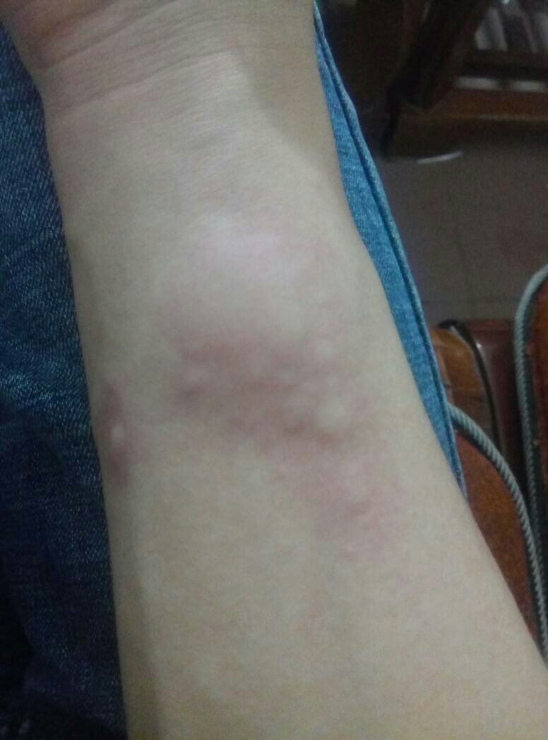 身上无缘无故起包很痒