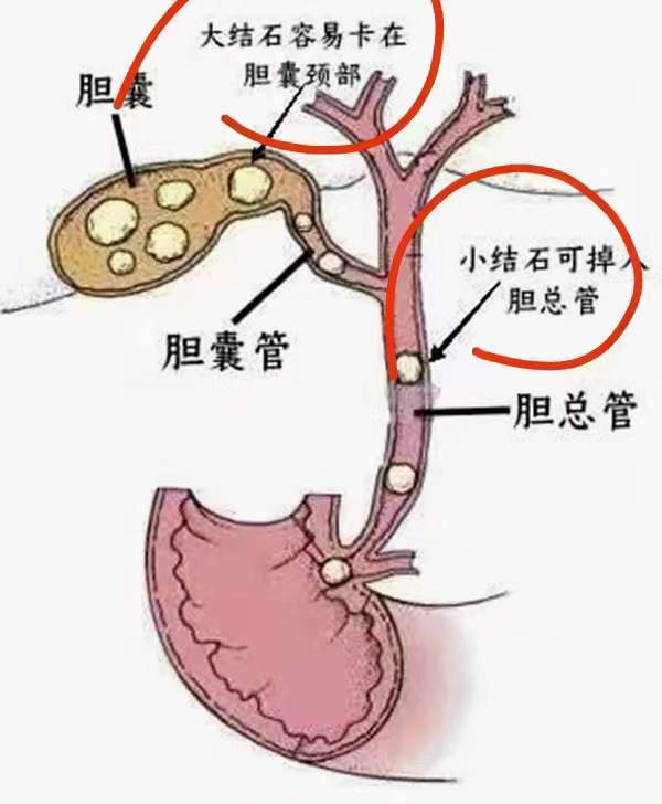 胆结石怎么形成的