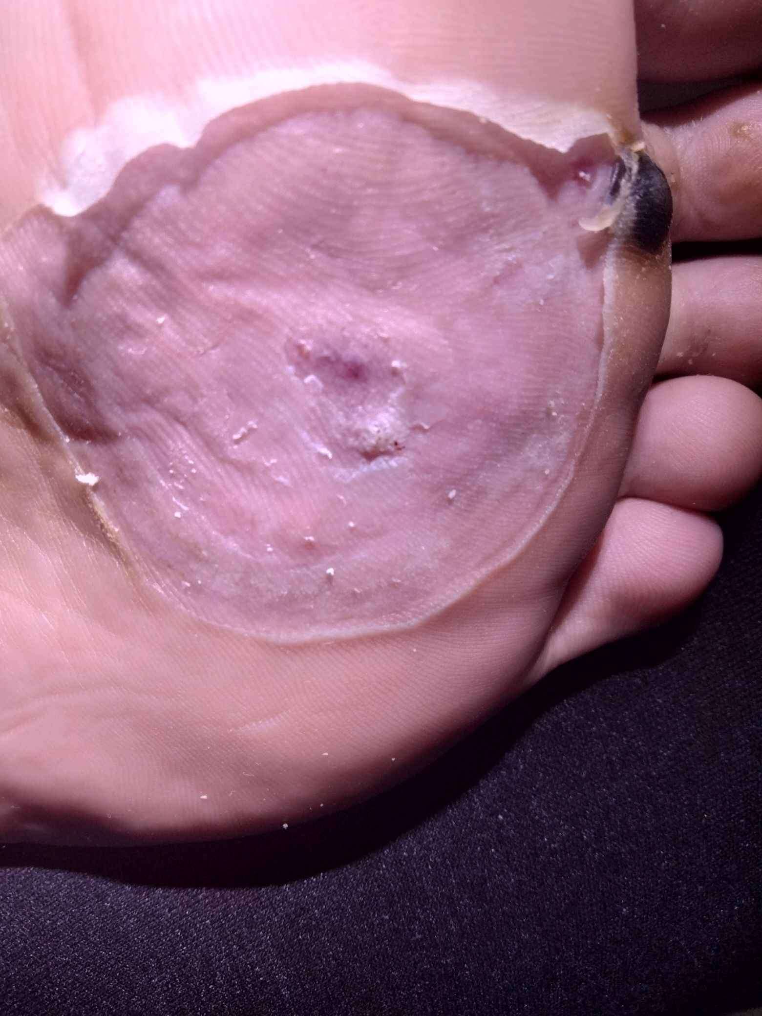 第一个图跖疣做了冷冻快20天了有点结痂了这个上面的