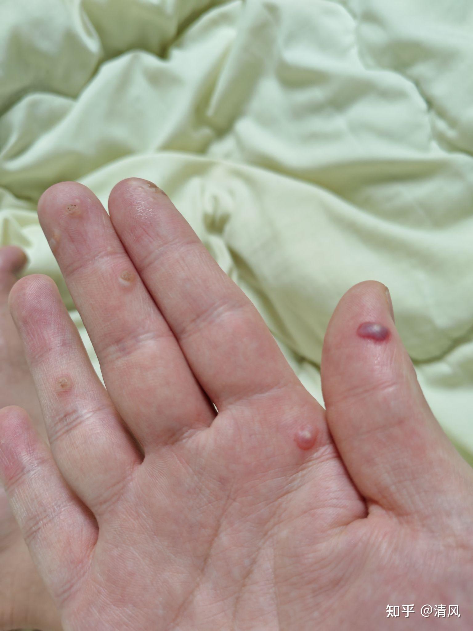 第一个图跖疣做了冷冻快20天了有点结痂了这个上面的