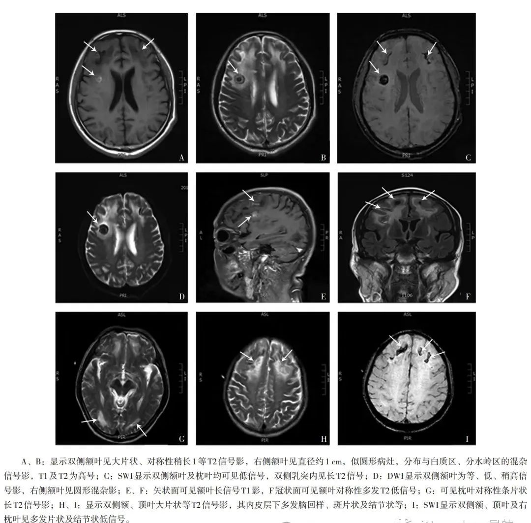什么是脑白质病
