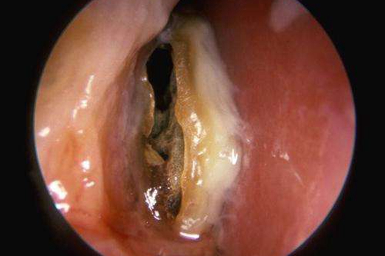 鼻子里流出黄色液体是什么