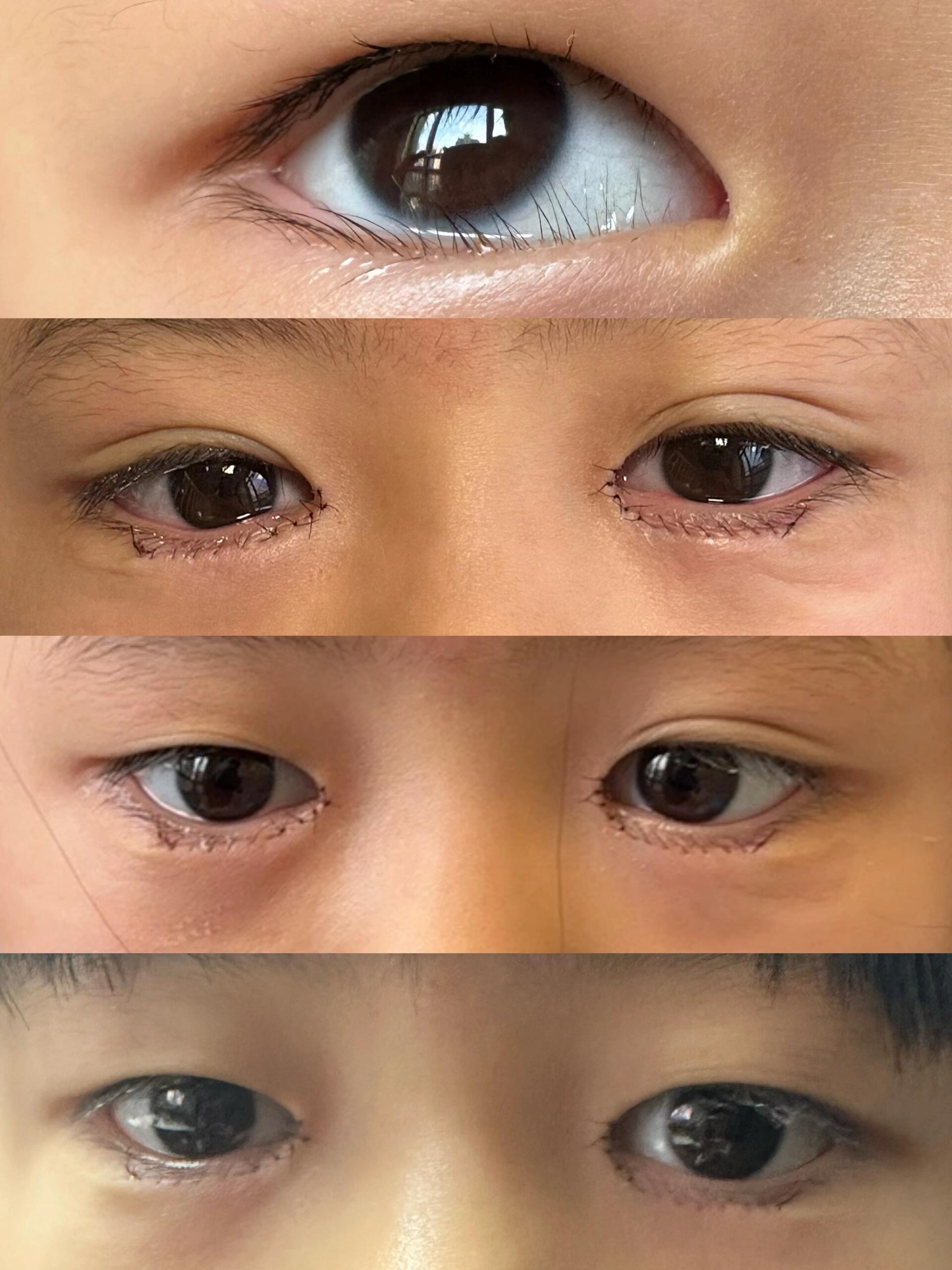 宝宝倒睫毛怎么办