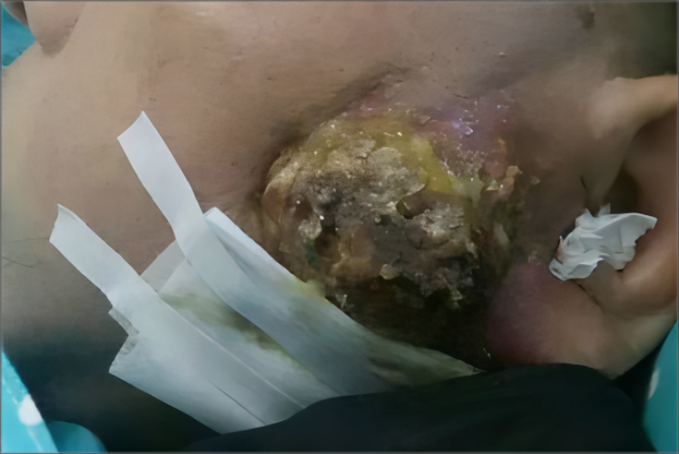 鼻咽癌的症状表现