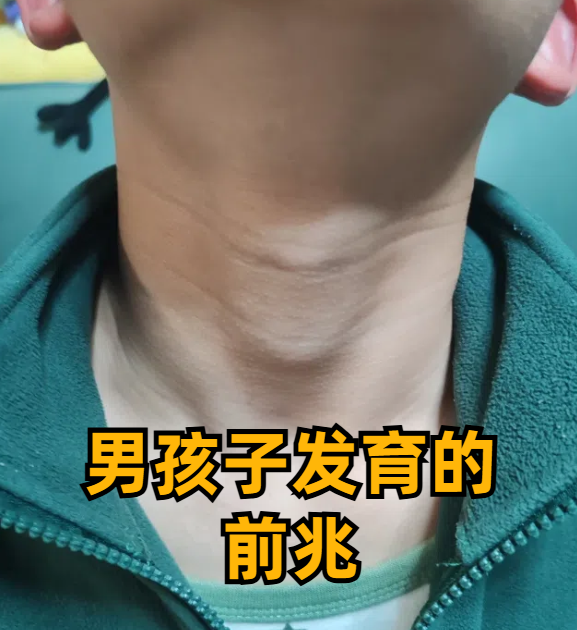 变声期有哪些症状??