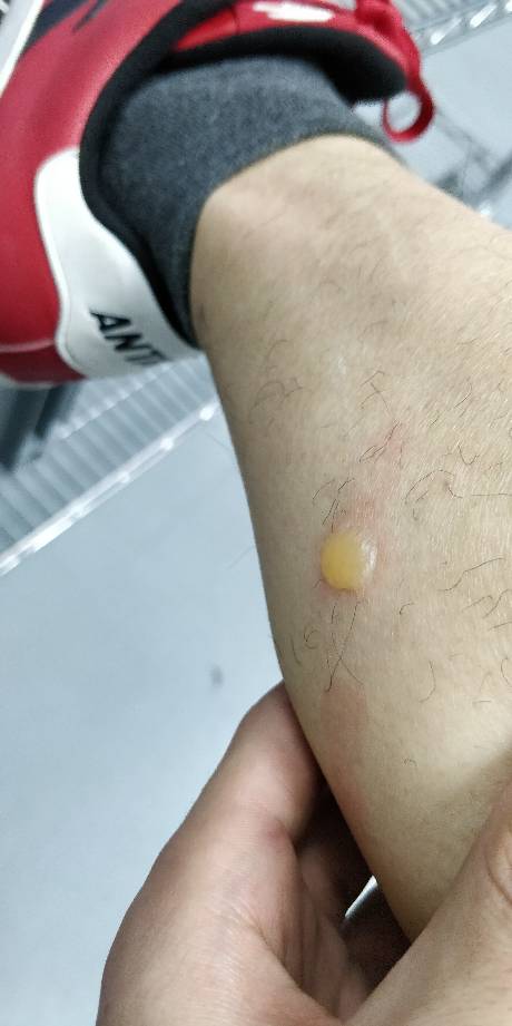腿上长了个白色的脓包