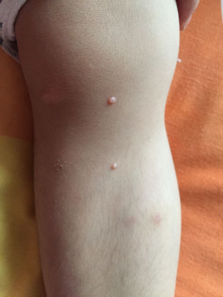 腿上长了个白色的脓包