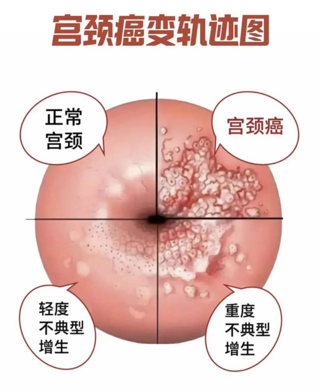 宫颈炎的症状有什么