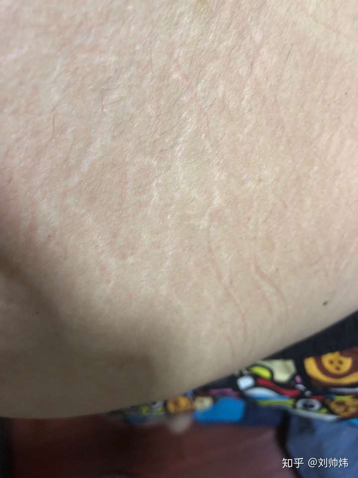 大腿两侧有红条