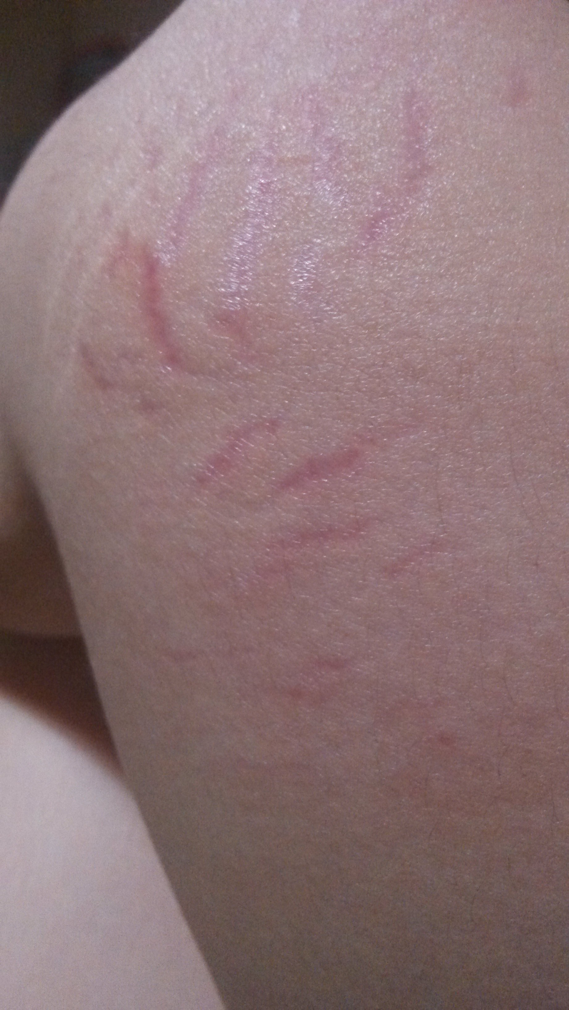 大腿两侧有红条