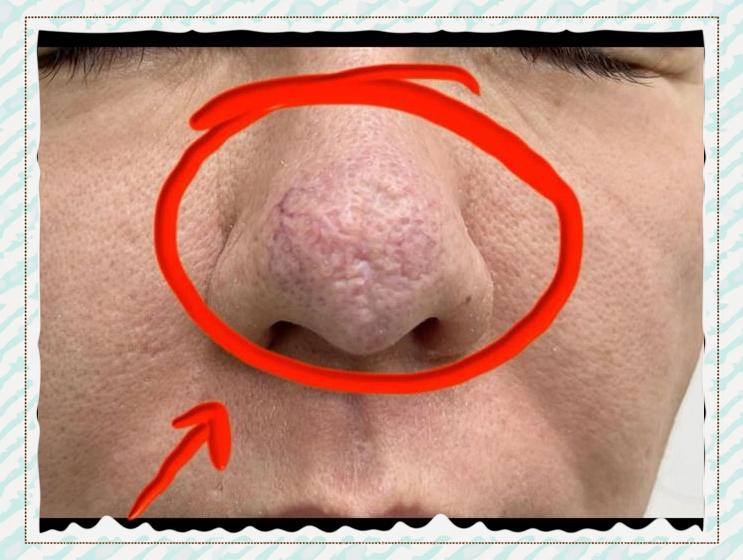 得了酒糟鼻怎么治疗