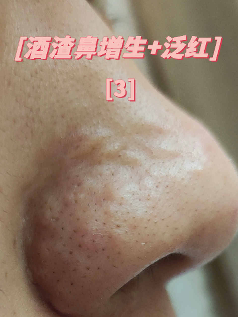 得了酒糟鼻怎么治疗