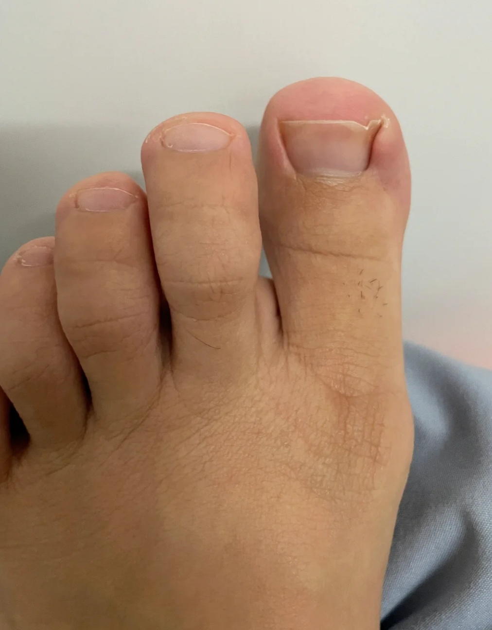 脚大拇指疼怎么回事