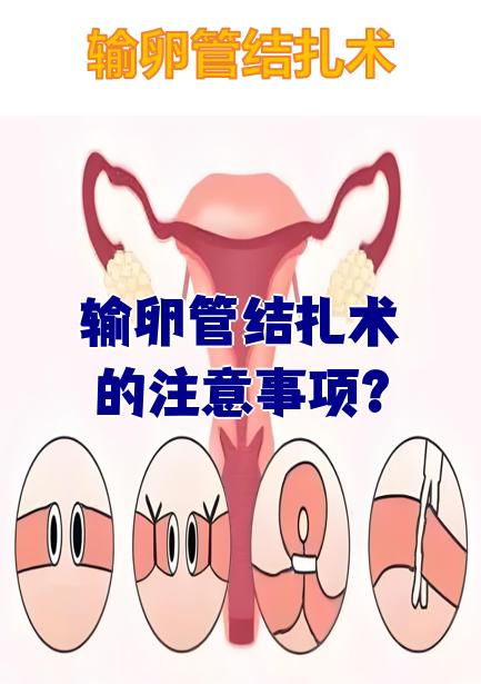 结扎是什么?