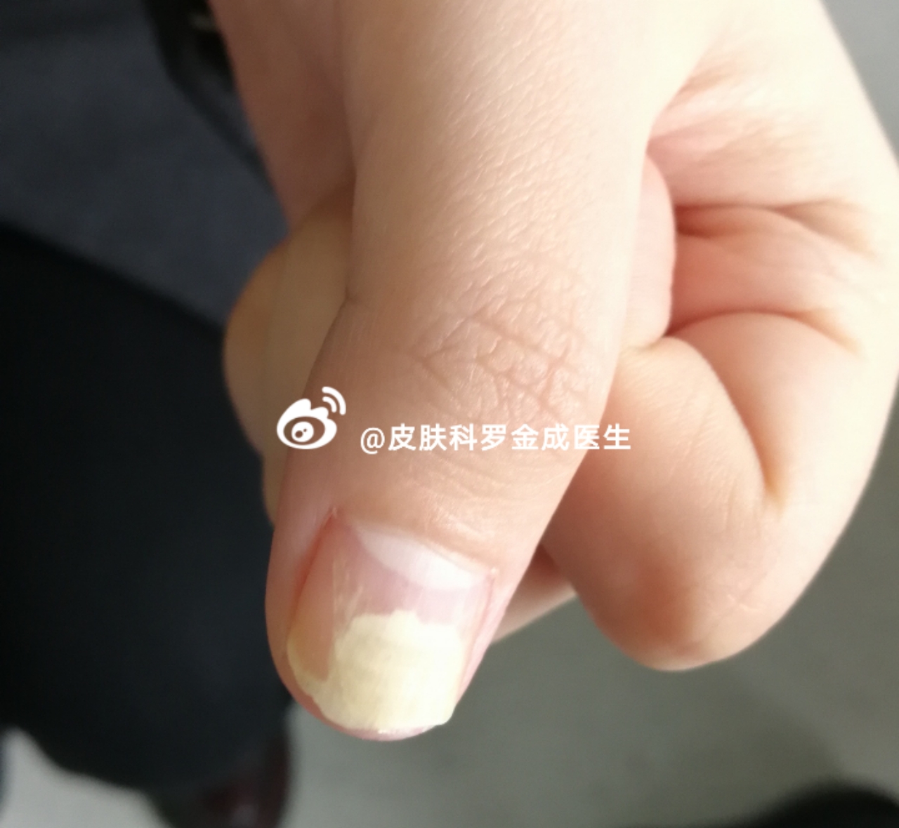 指甲根部和肉分离是啥?